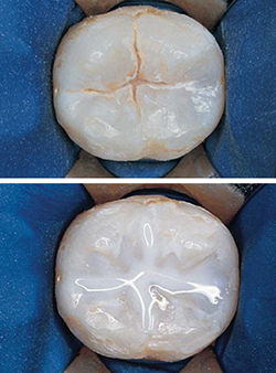 sealants
